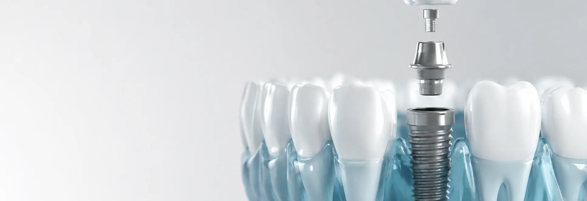 Computer guided dental implants at Dental Arts Davis Square
