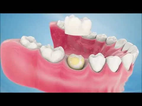 YouTube video player — What is a Porcelain Crown