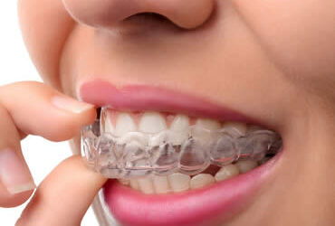 Should My Teen Opt for Invisalign or Traditional Braces?