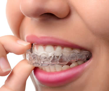 Should My Teen Opt for Invisalign or Traditional Braces?